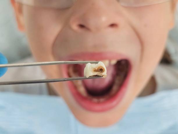 Best Urgent Care for Lost Fillings or Crowns in Spring Grove, PA